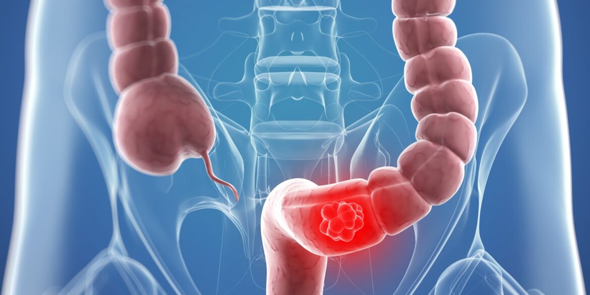 CANCER وزارة الصحة: أكثر من 4 آلاف حالة إصابة بسرطان القولون سنة 2024