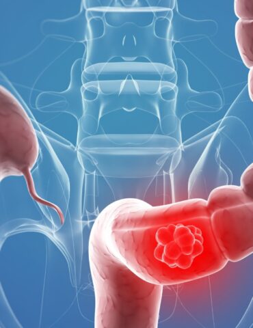 CANCER وزارة الصحة: أكثر من 4 آلاف حالة إصابة بسرطان القولون سنة 2024